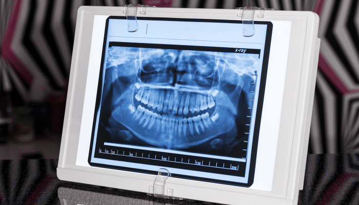 Why you should get a dental x-ray | Dental x-ray benefits